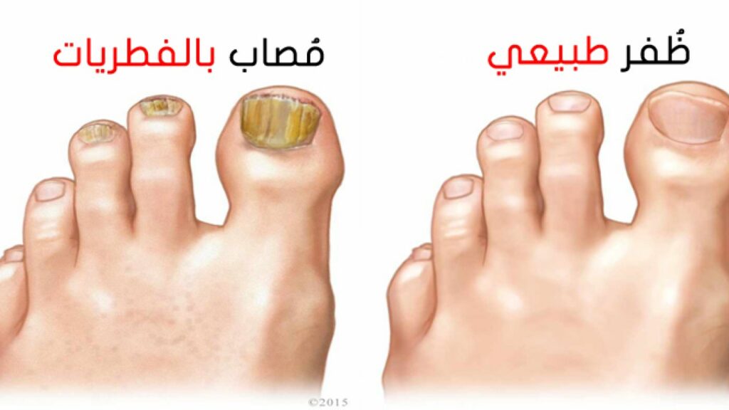صودا الخبز وخل التفاح علاج لفطريات أظافر القدم