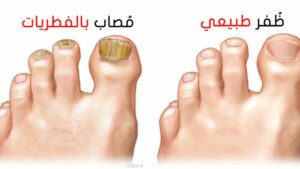 صودا الخبز وخل التفاح علاج لفطريات أظافر القدم