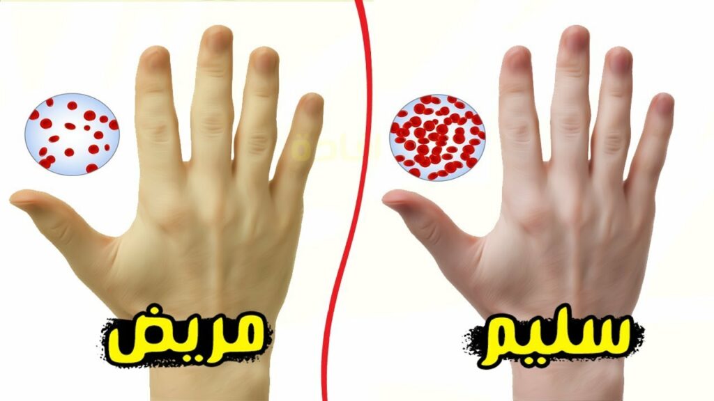 أخطار نقص الحديد في الجسم