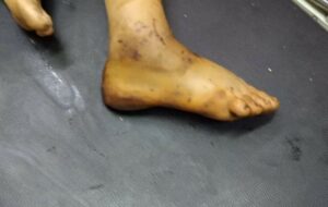 لدغة أفعى ترسل فتاة إلى المستشفى بإقليم تنغير